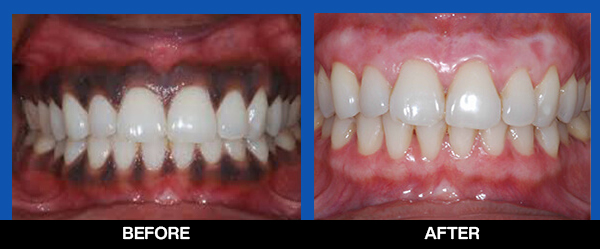 https://www.pearldentlko.com/wp-content/uploads/2024/08/service-cosmetic-dentist-Gum-Depigmentation-last-iamge.jpg