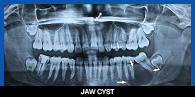 services, Oral Cysts & Tumors, 3rd left image