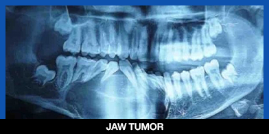 services, Oral Cysts & Tumors, 4th right image