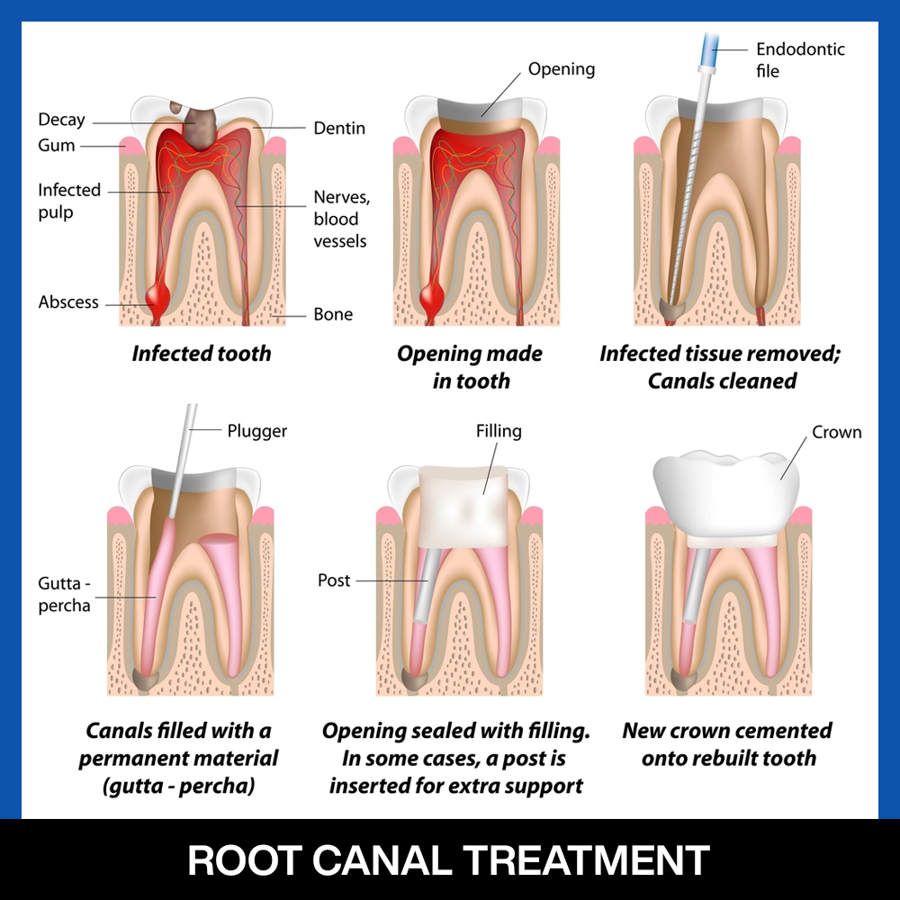 https://www.pearldentlko.com/wp-content/uploads/2024/08/services-root-canal-treatment-RCT-botom-image.jpg