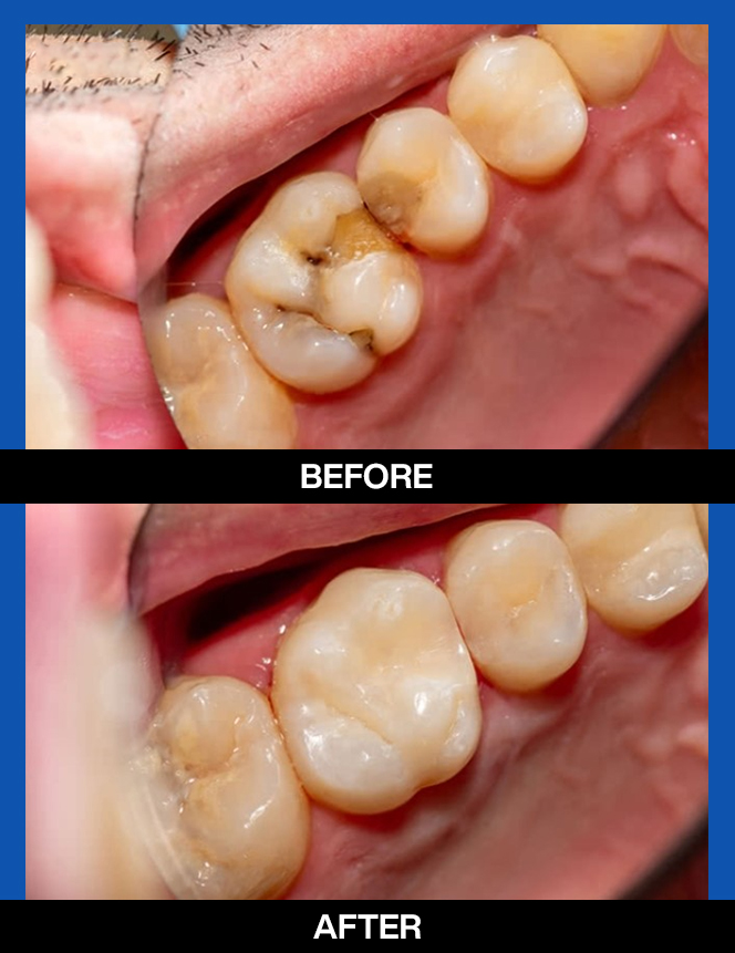 services, tooth color filings, center second image copy
