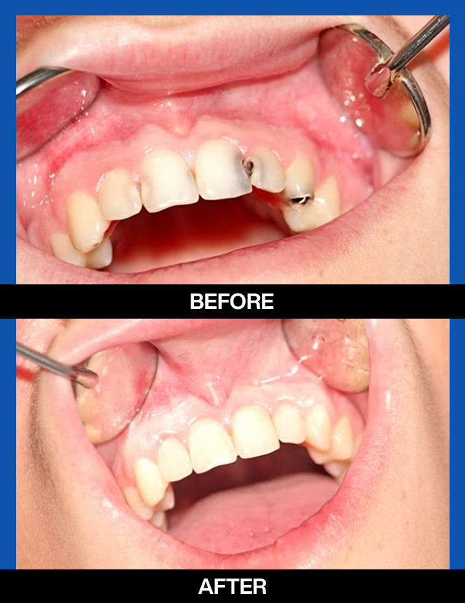 services, tooth color filings, left first image