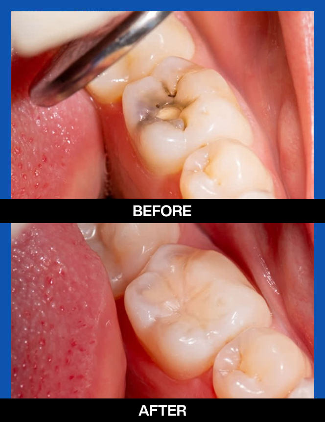 services, tooth color filings, right 3rd image copy